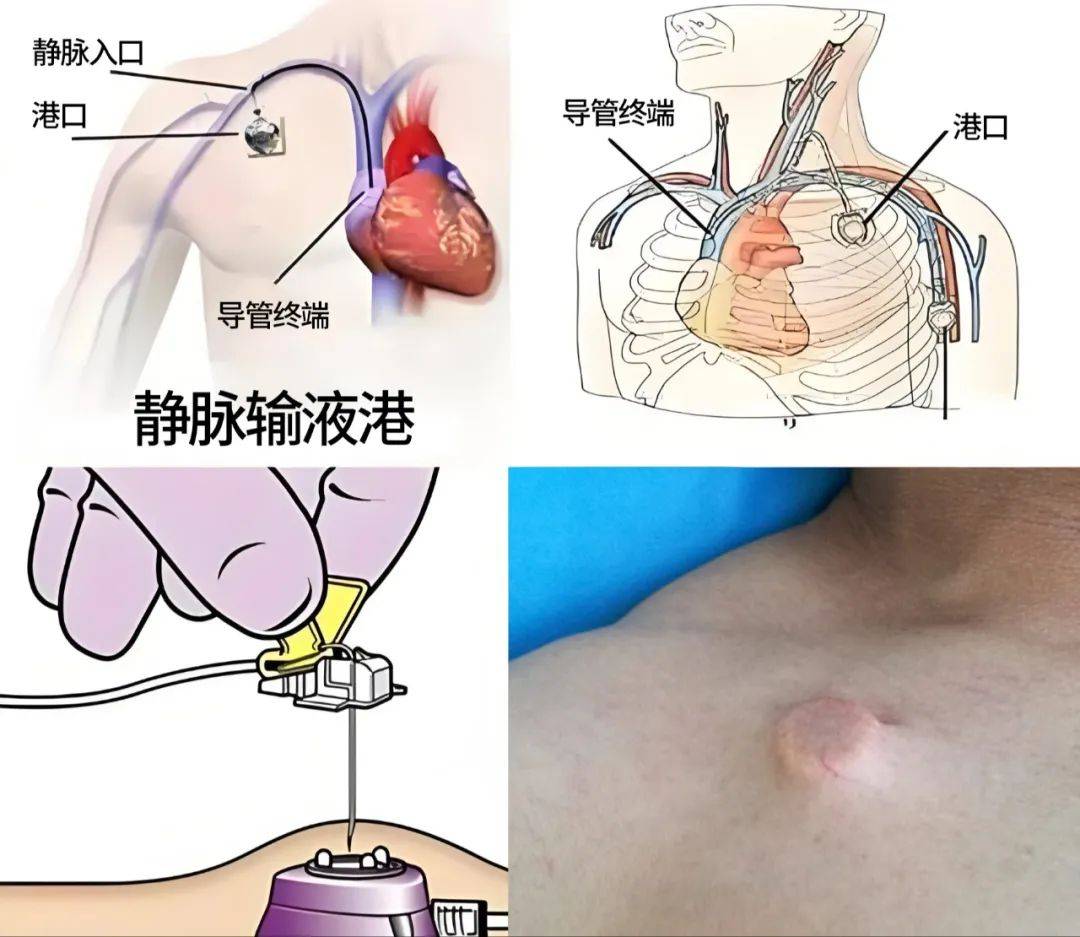 我院普外,胸外科为乳腺癌术后患者成功实施输液港植入术