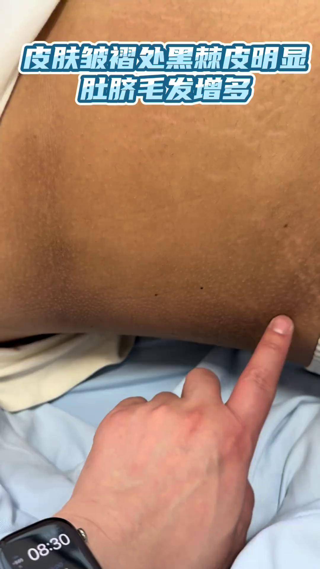 黑棘皮容易出现在皮肤皱褶的地方 视频仅供参考如有不适请线下就医 黑