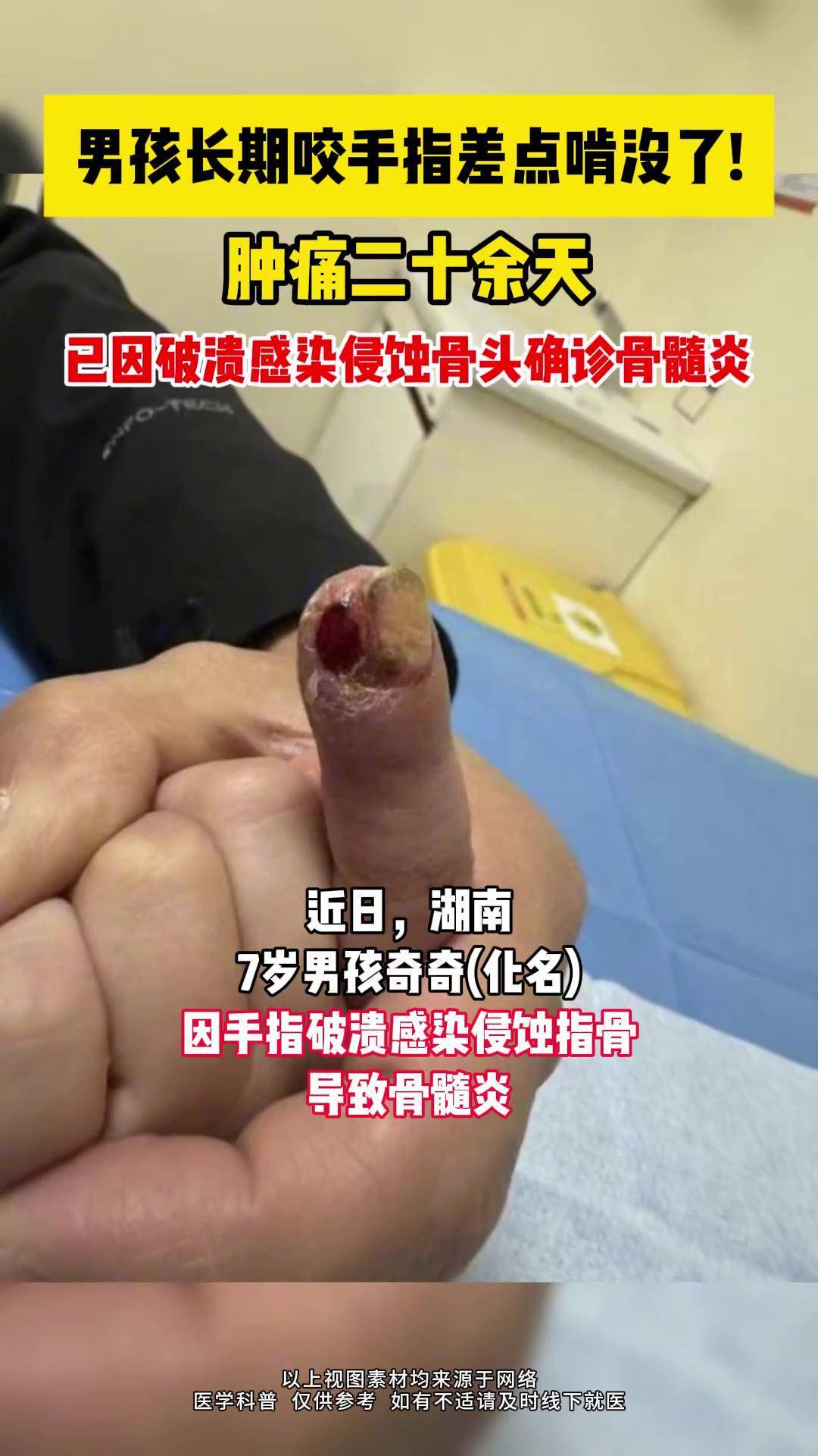 7岁男孩长期咬手指,破溃感染骨髓炎. 热点 育儿 涨知识 啃手指