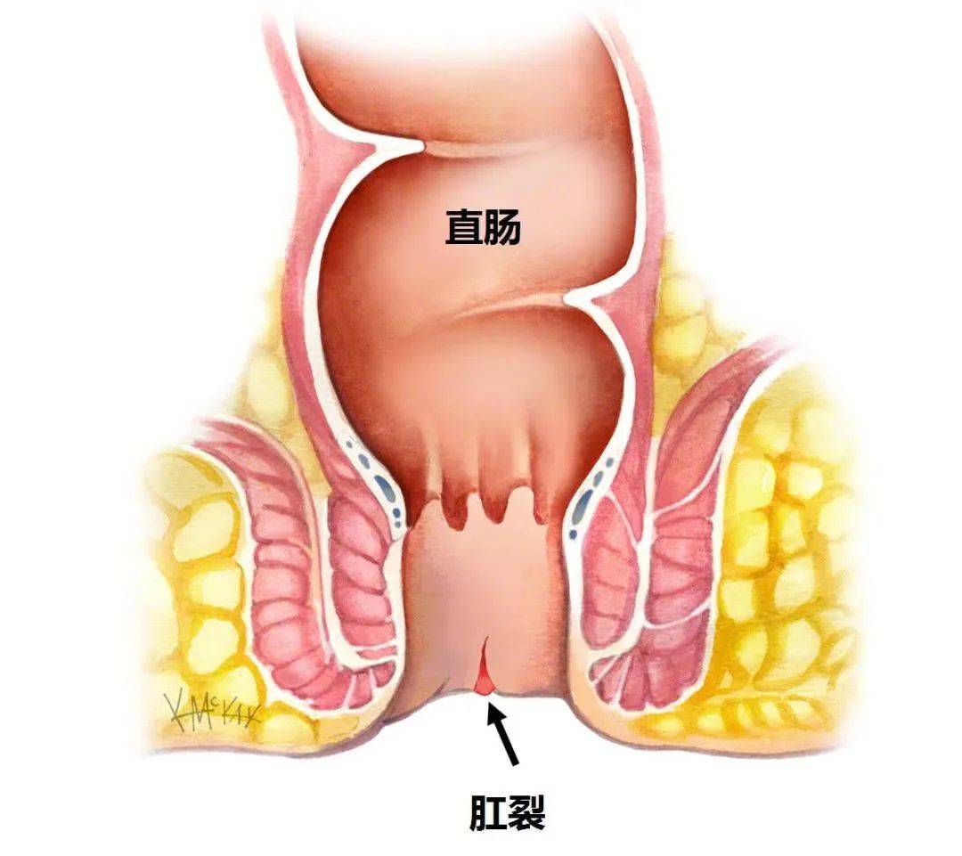 肛瘘_肛门_直肠