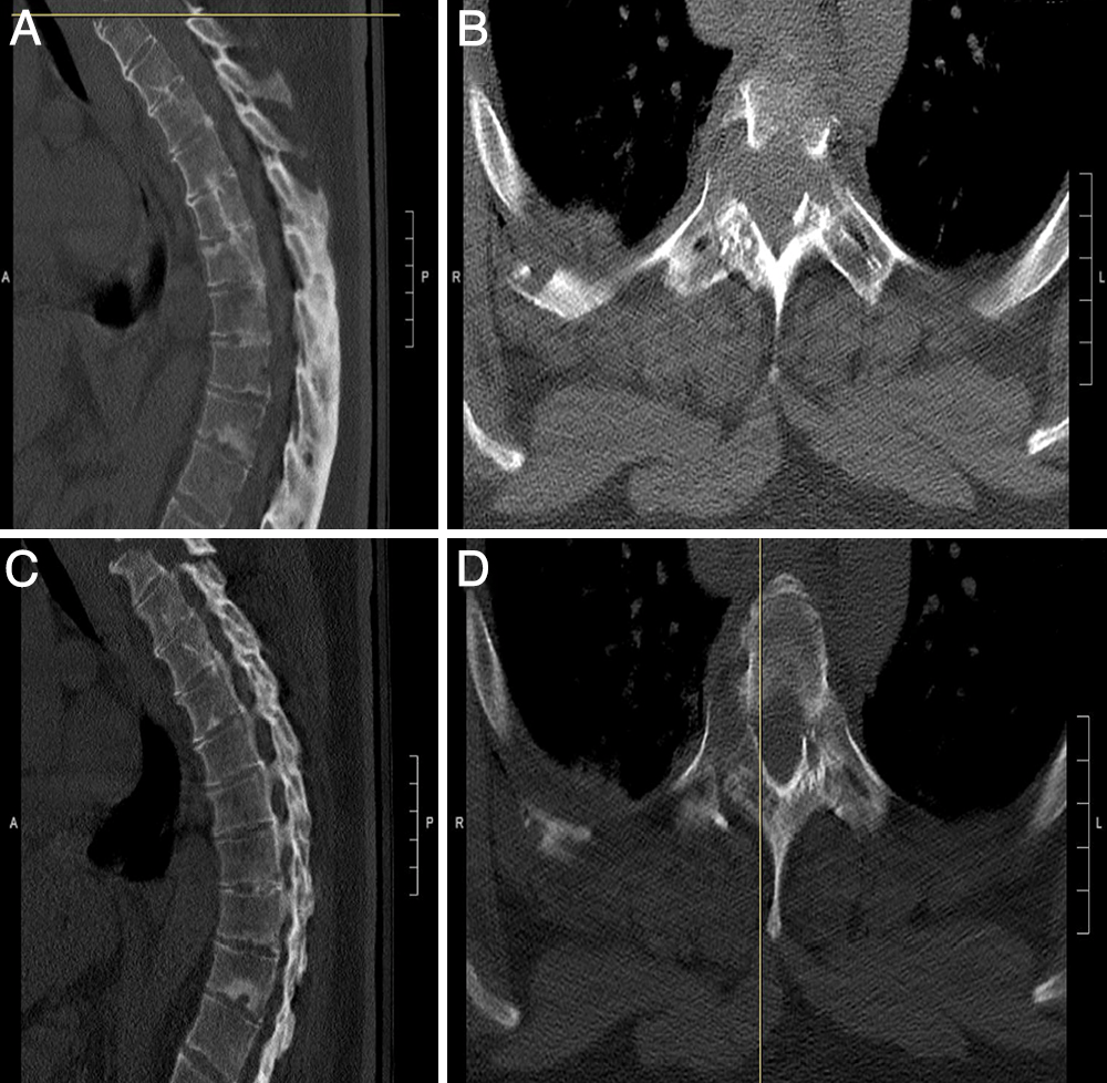 神外早8点手术有新译单一后路处理晚期强直性脊柱炎患者颈胸腰椎多节
