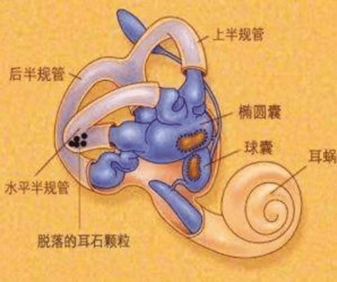 一文读懂耳石症的自救与康复