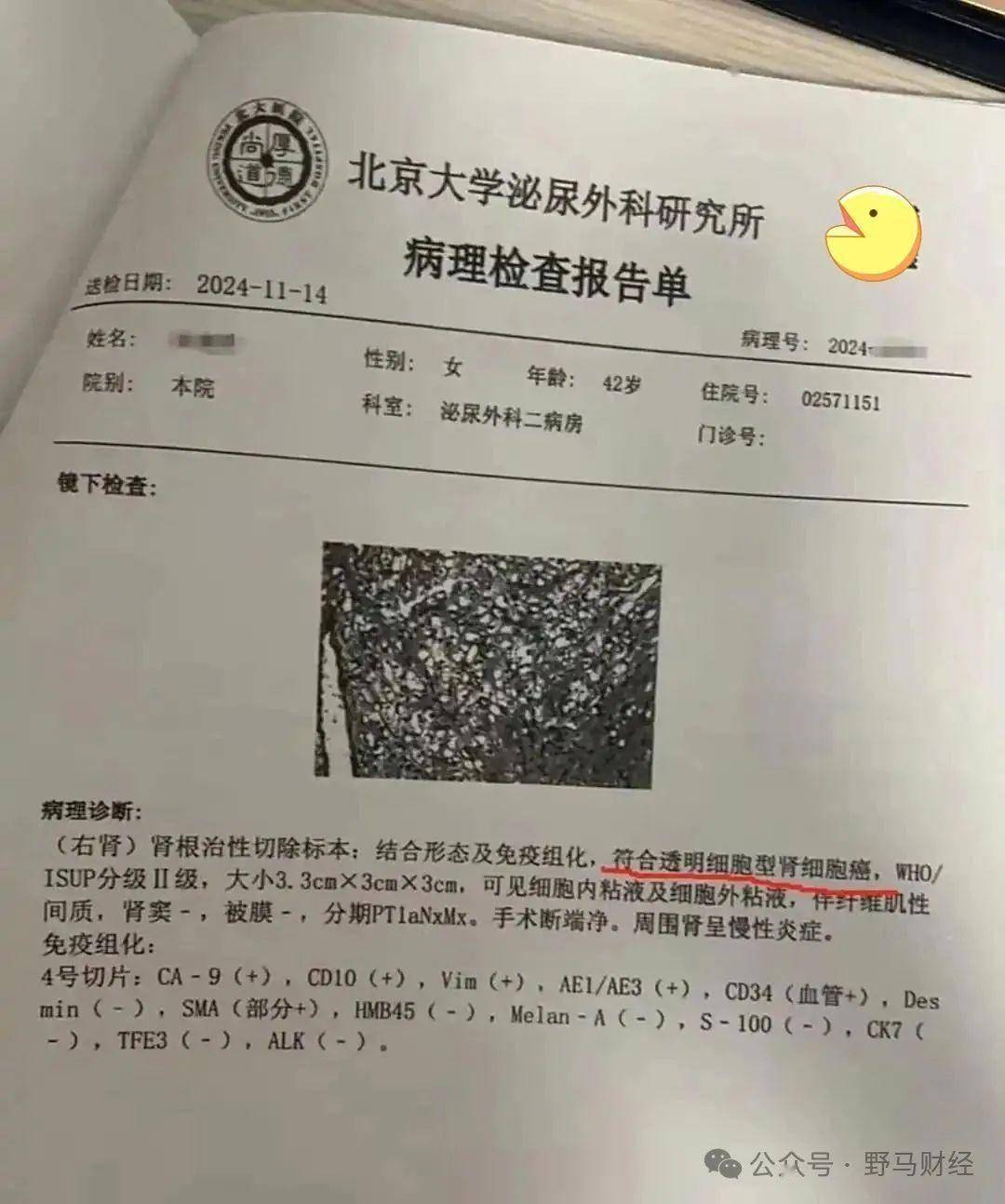 随后的手术切除了右肾,病理确诊为"透明细胞型肾细胞癌"