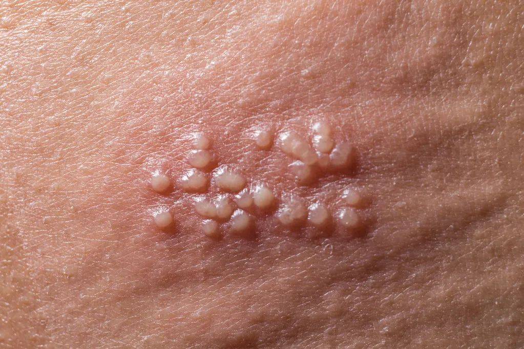 这几年,我陆陆续续将这款草药推荐给很多疮疹患者,都是快的一天,迟的