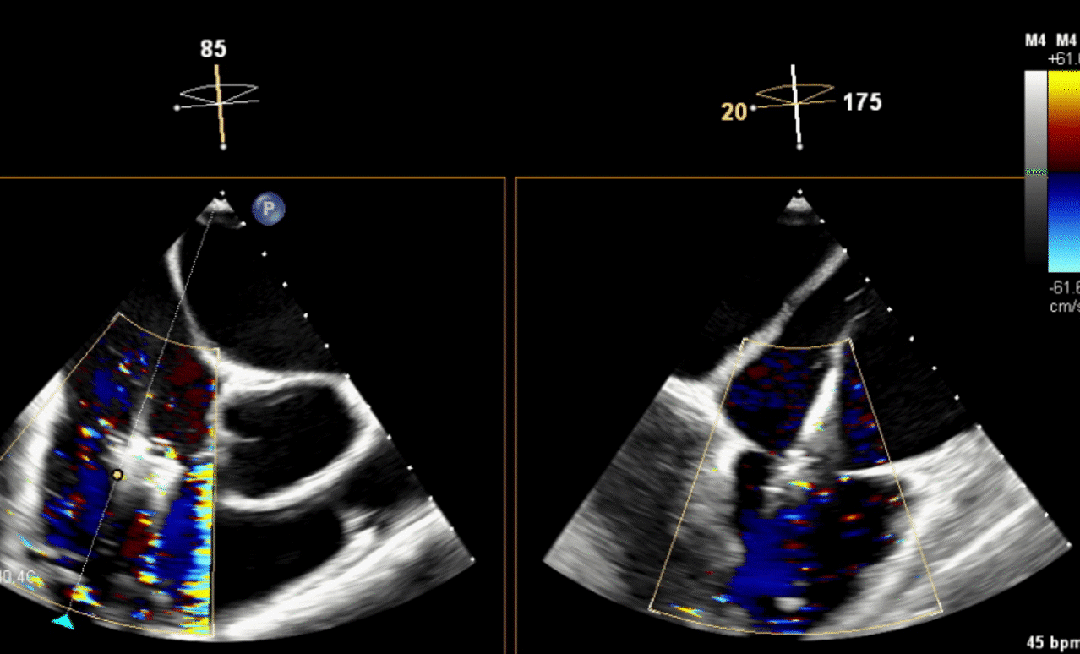 宁波市首两例经导管三尖瓣teer成功实施
