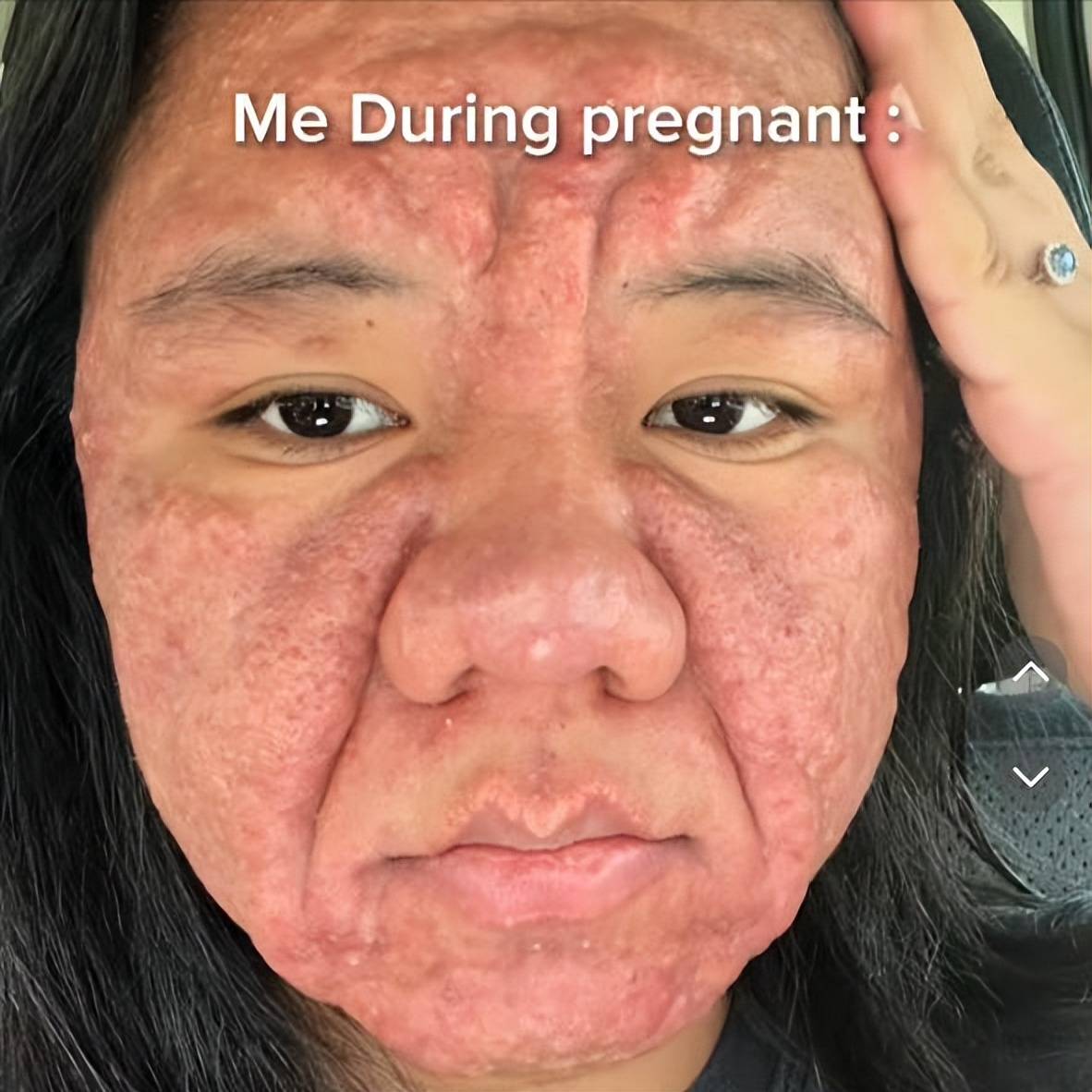 孕前娃娃脸大学生,孕后直接毁容,满脸长痘,网友:这是一个人?