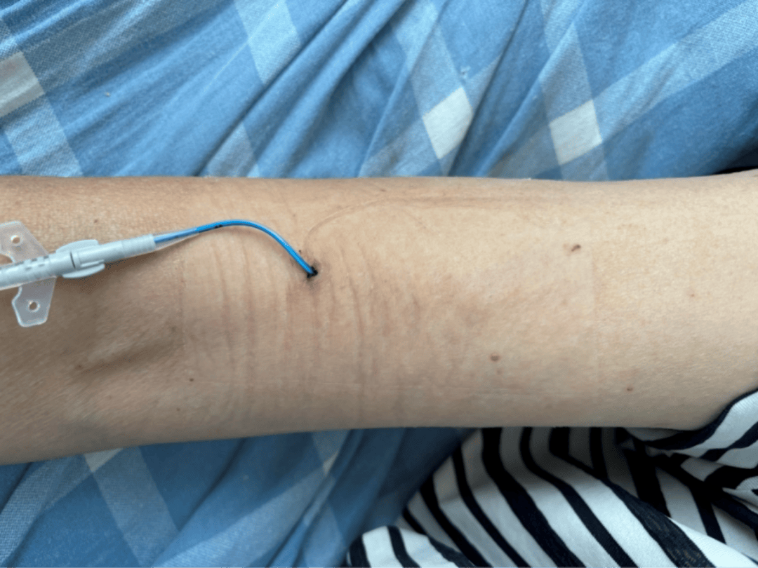 picc置管后出现红色条索这种静脉炎你可能没遇过