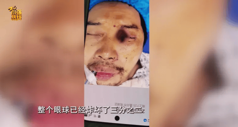 突然炸了！浙江一男子眼球被炸破，元凶是它？夏天不少人会接触
