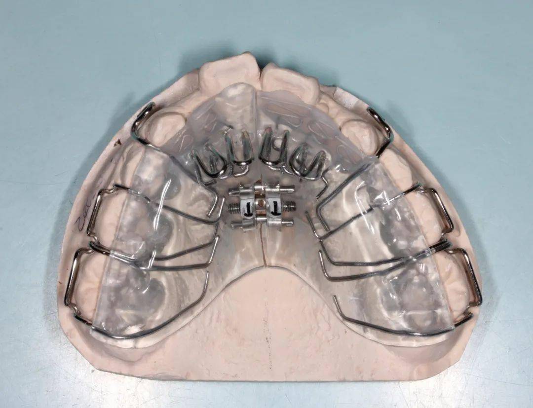 儿童正畸:这些信号别忽视,黄金期干预很关键