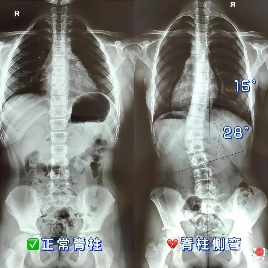入院检查显示,小雨脊柱呈s形弯曲(胸椎右后凸,腰椎左凸),存在明显"
