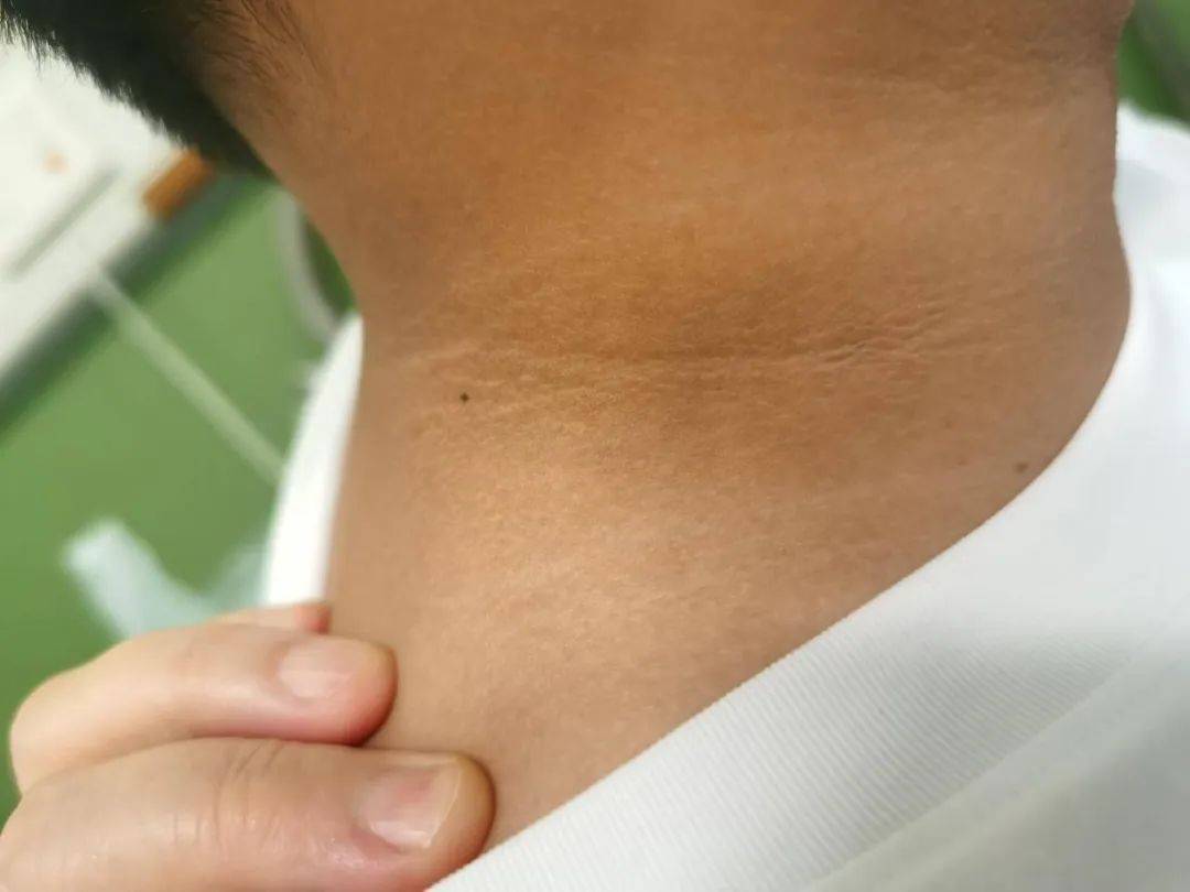 9岁男孩脖子黑洗不掉?到医院一查,糖尿病,脂肪肝都找上门了!