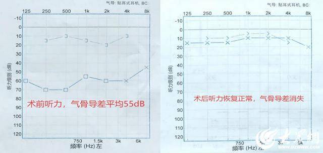 东营首例！胜利油田中心医院成功实施复杂先天性中耳畸形听力重建术