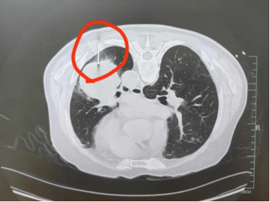 71岁爷爷的“高危穿刺”：当肿瘤挨着心脏，医生这样做……