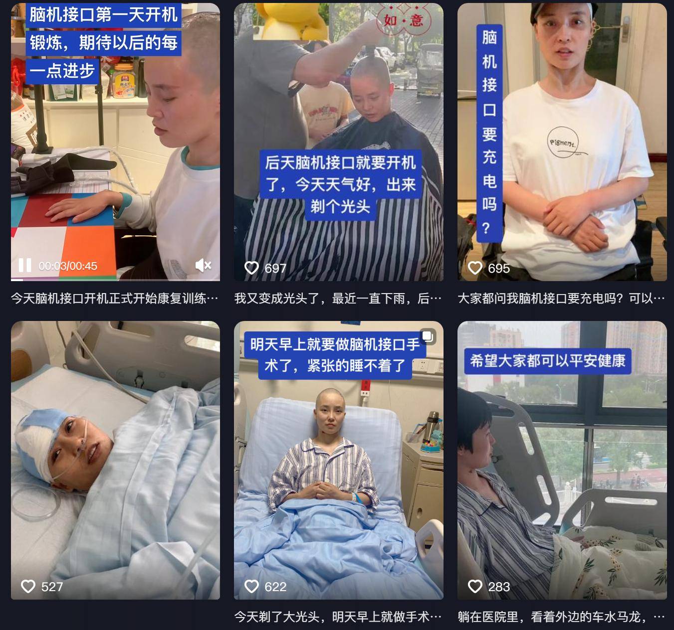 女子因车祸全身瘫痪6年仅嘴眼能动，接受脑机接口手术后通过意念抓取物品！当事人讲述