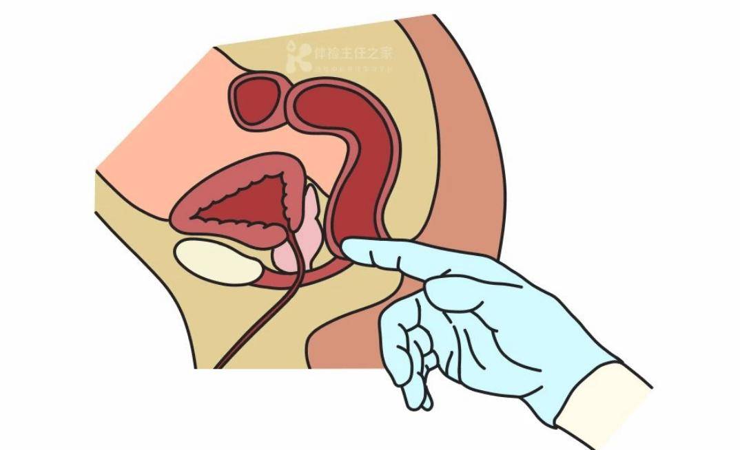 关于肛门指检,一个你不敢问但必须知道的体检项目