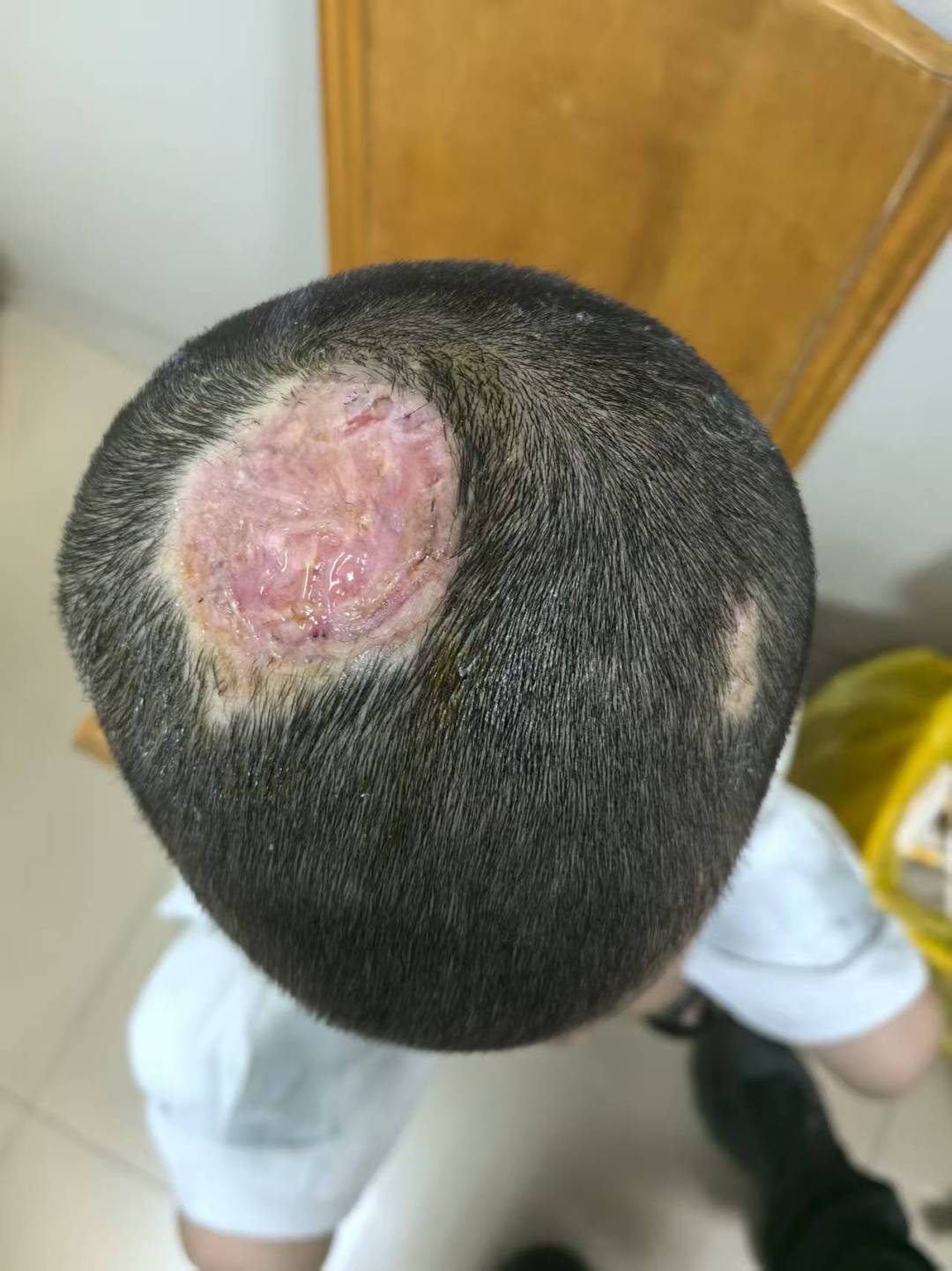 6岁小男孩领养了只兔子，没想到头上长出脓包，反复溃烂，竟导致永久秃发！