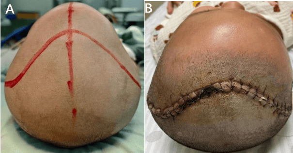 标准化额眶前移术治疗三角头畸形
