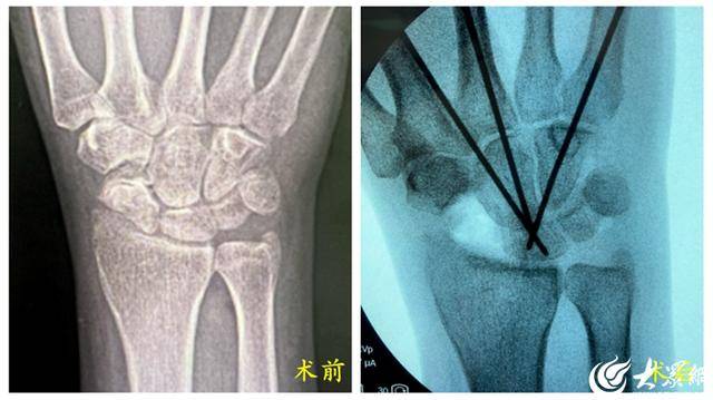 新突破！胜利油田中心医院完成东营首例高难度微创融合手术