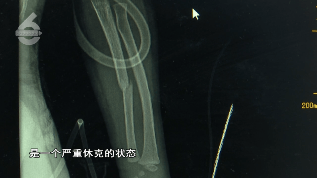 昆明一5岁女童从23楼坠落，奇迹生还！