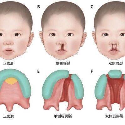 儿童唇腭裂:你需要了解的那些事_治疗_et_患儿