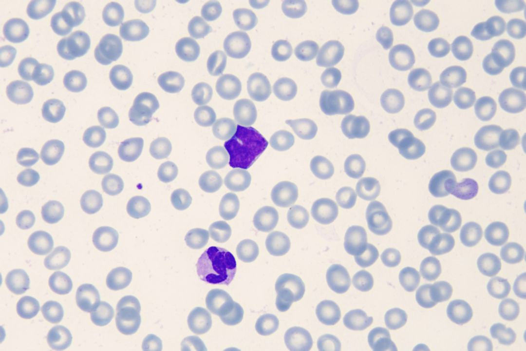 儿童单核细胞增高原因探索