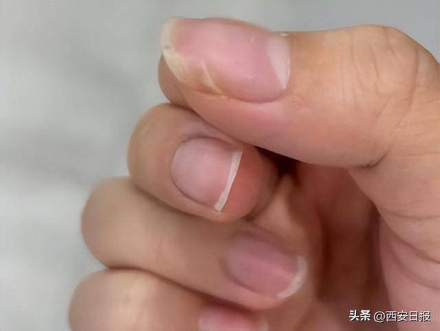 指甲有竖纹是肝不好？易断裂是缺钙？澄清6个指甲传言