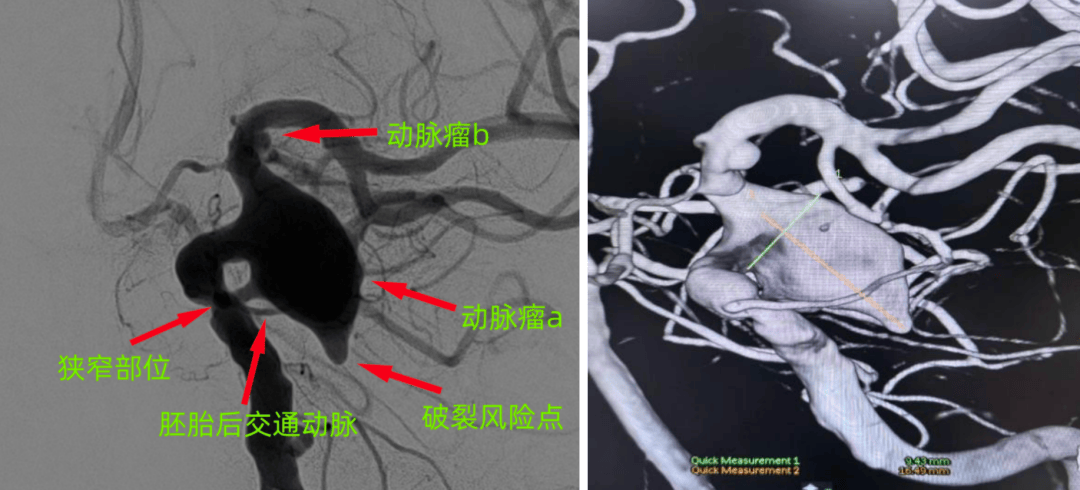 医路前行|“精准拆弹”闯禁区——我院神经外科血管介入团队成功救治高龄复杂颅内动脉瘤患者