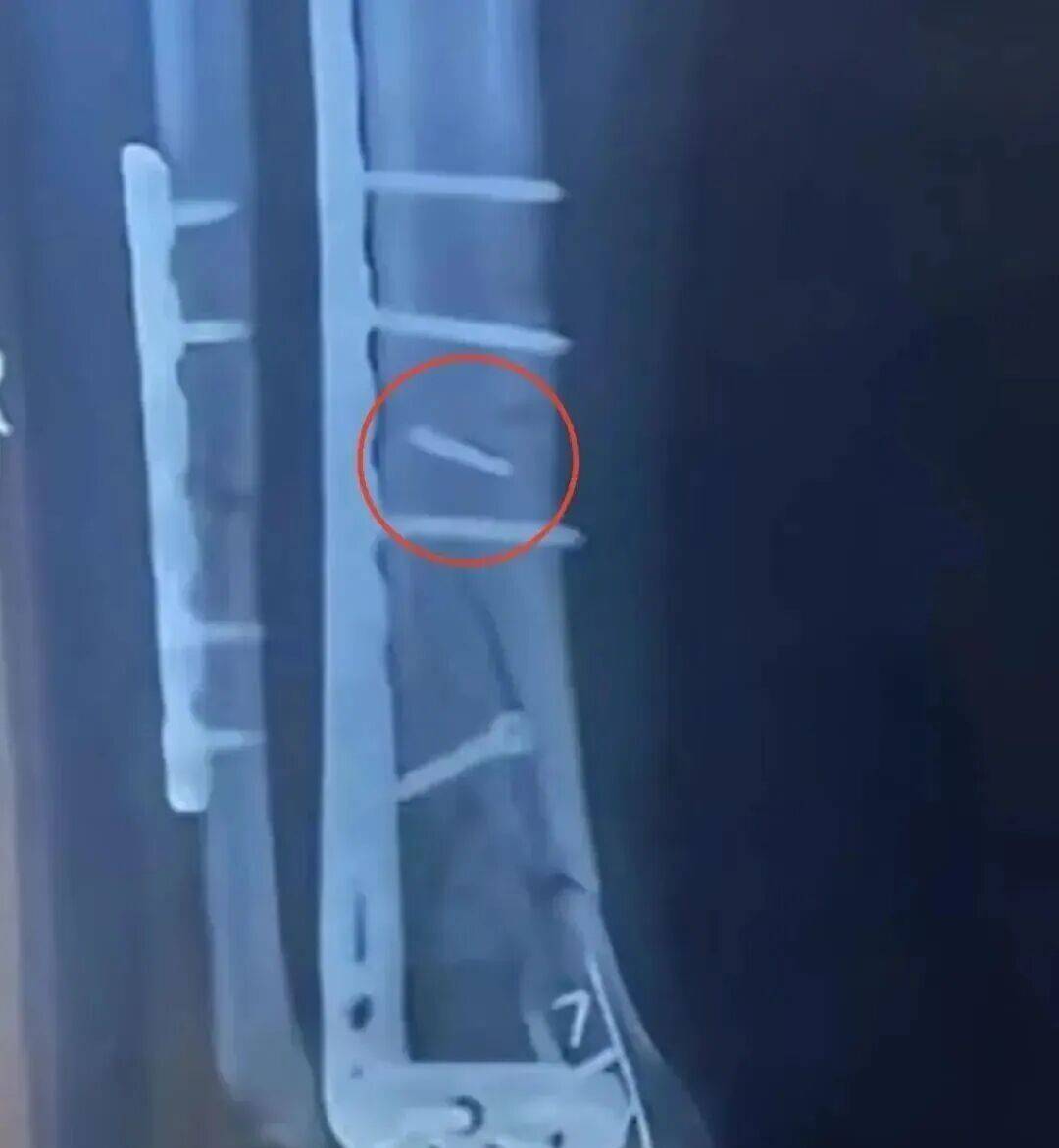 两人同病房同一天手术，体内都遗落手术钻头，医院和患者达成和解，相关医师此前已被行政处罚