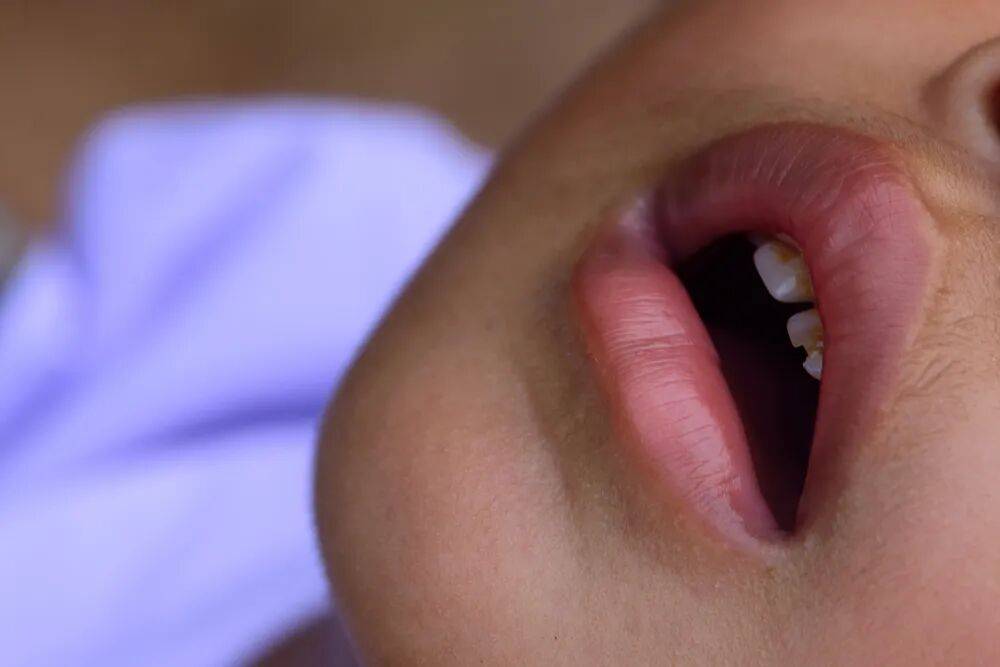 孩子嘴巴翘是腺样体面容吗？