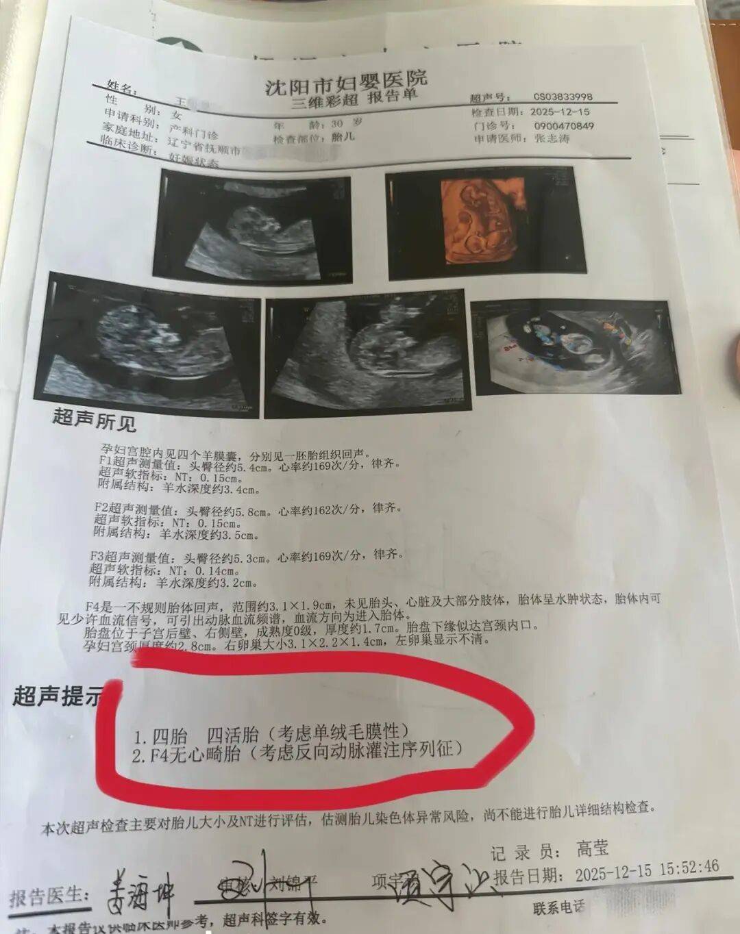 辽宁一孕妇两个月内从一胎变四胞胎