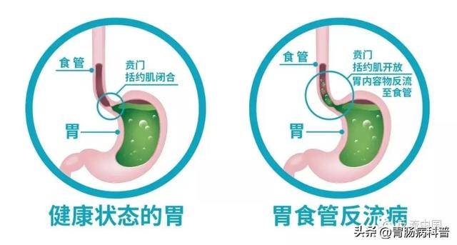 反流性食管炎防治指南：从检查、治疗到预防，一文掌握_黏膜_压力_小时