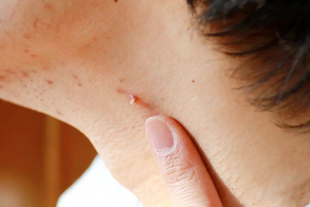 当妈后,乳晕上长出的小疙瘩是什么？需要担心么？