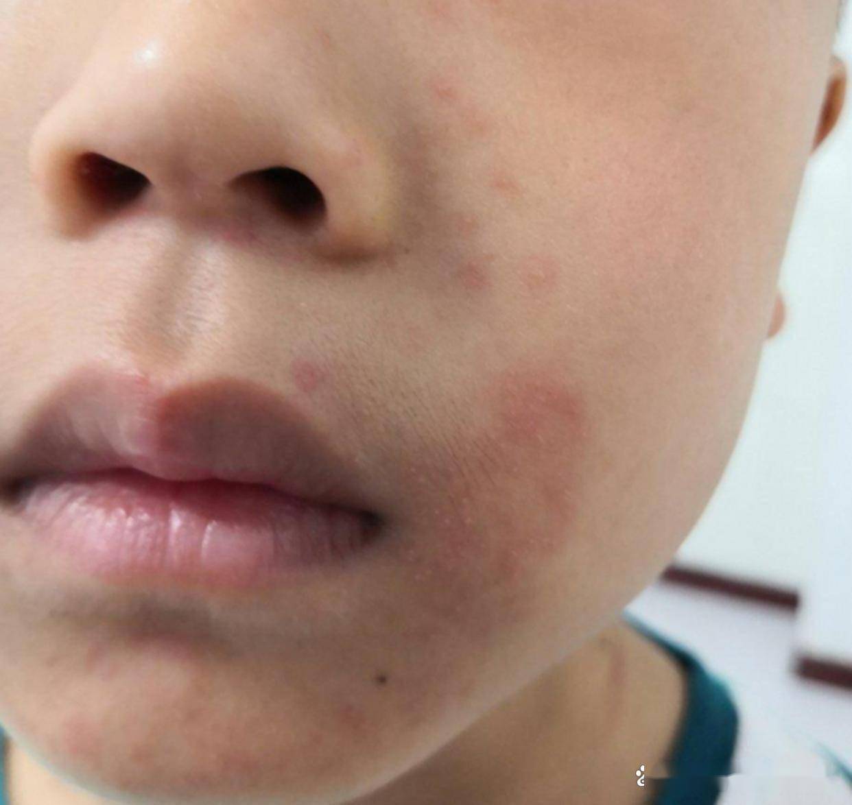 冬季高发！孩子舔唇竟染羊胡子疮，别再当“上火”