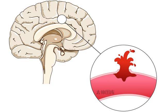 近 300 斤小伙反复减肥后，突发脑出血险丧命！医生：身体早就受不了了