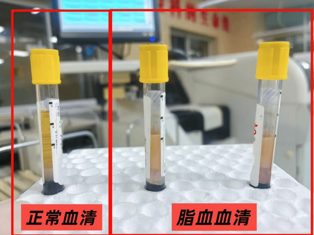 春节临近,警惕脂血标本“亮红灯”——高脂饮食+饮酒易诱发胰腺炎,这份健康提示请收好_指标_临床_生化