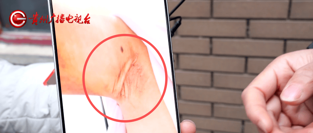 贵阳女子花7500元祛狐臭 翡丽斯整形术后腋下出现5厘米疤痕(图1)