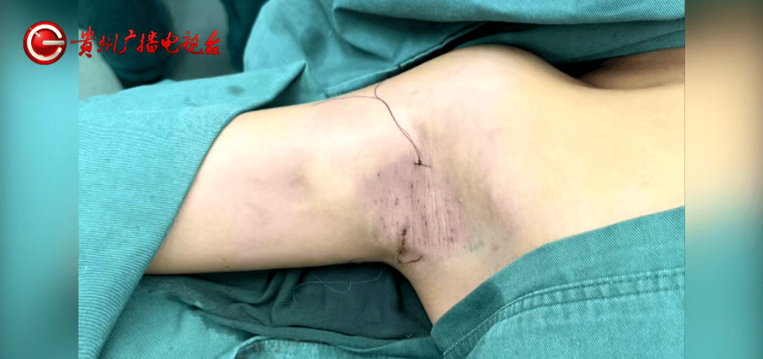 贵阳女子花7500元祛狐臭 翡丽斯整形术后腋下出现5厘米疤痕(图7)