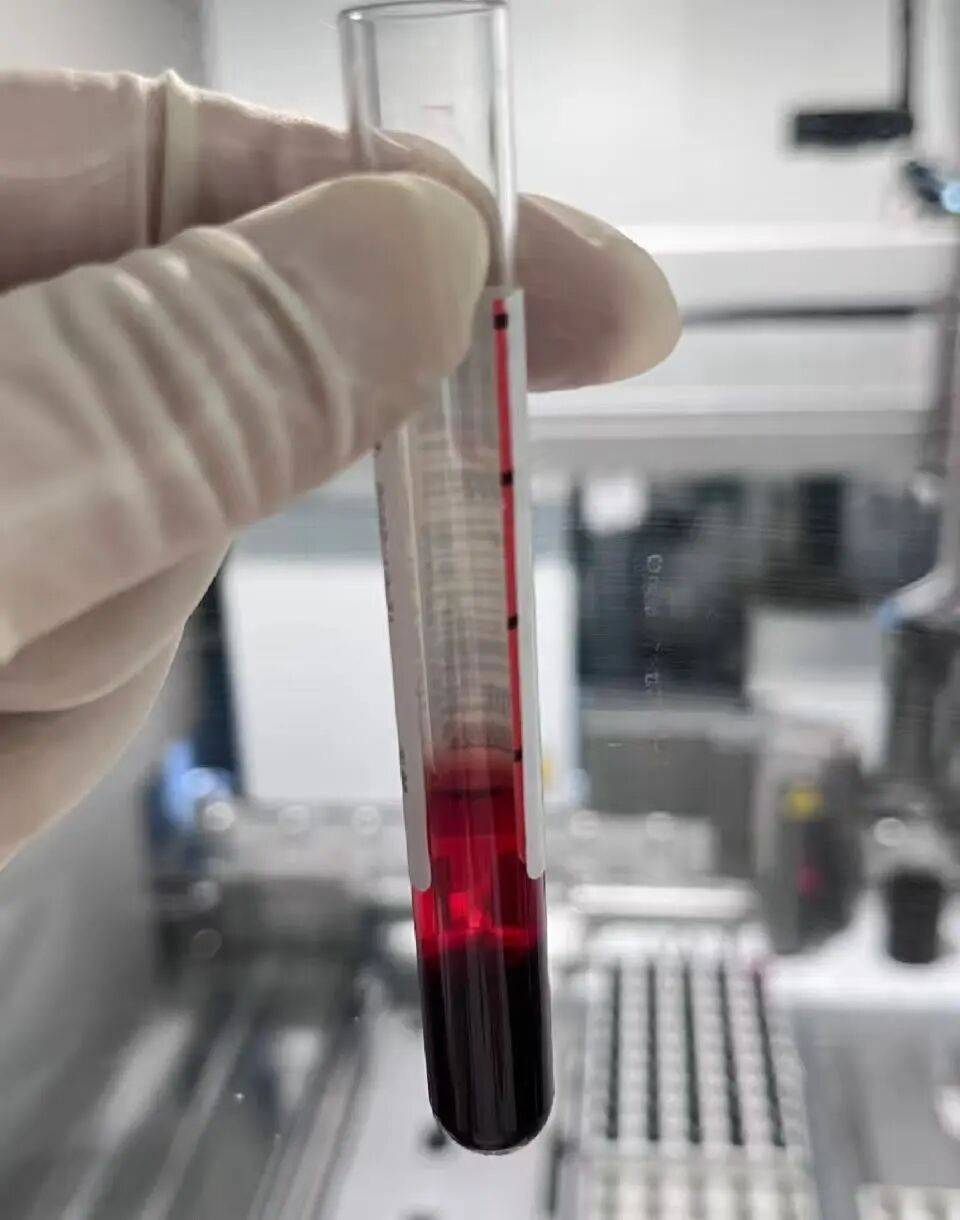 【健康解码】溶血标本对临床检验结果的影响_红细胞_干扰_项目