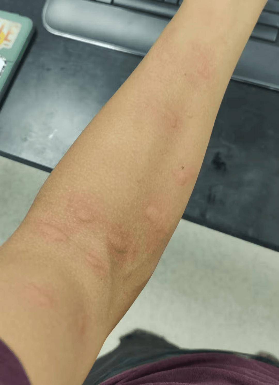 蚊子_研究人员_患者