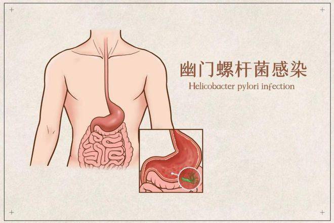 幽门螺杆菌不是小喽啰，是胃癌的先锋军！