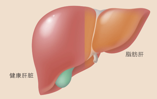 脂肪肝真能“逆转”吗？这里有一份实操指南……
