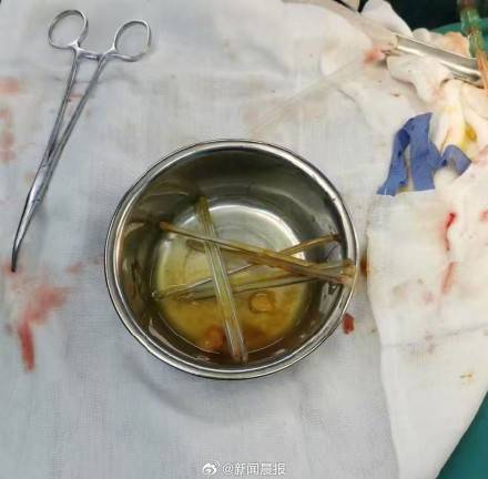 男子吞铁钉轻生半路后悔，上海医生紧急手术取出7枚铁钉