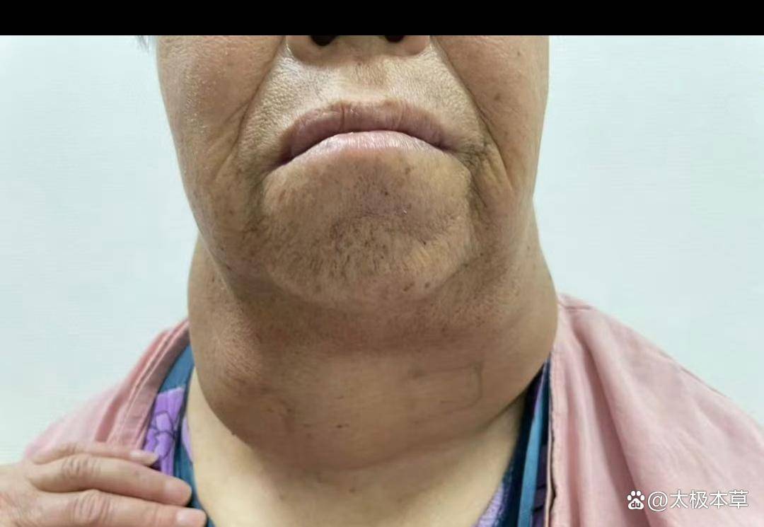 原创            甲状腺肿大、急躁易怒！李英杰前辈自拟方夏梅甲亢平！