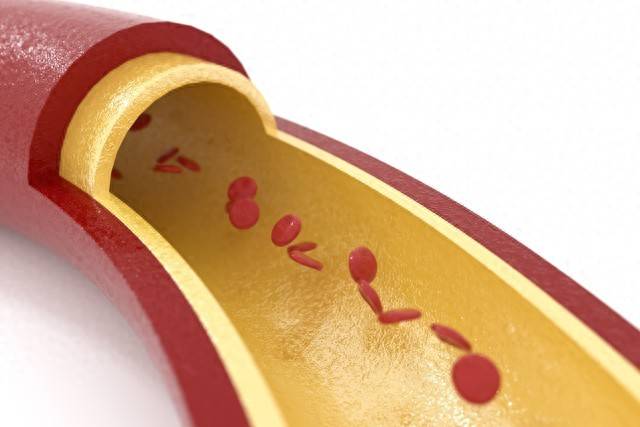 原创            鸡蛋黄被发现！医生研究发现：吃得越多，脑梗患者血管或越干净？
