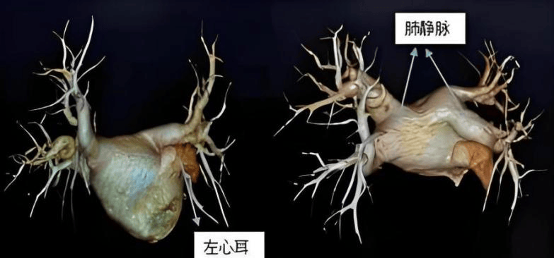 左心耳 CTA检查——心源性脑卒中筛查的新选择_临床_患者_血栓
