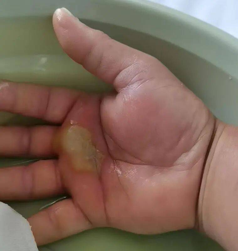 鱼刺扎一下,差点被“吃”掉?医生提醒:72小时不干预,病死率近100% (pic1) 鱼刺扎一下,差点被“吃”掉?医生提醒:72小时不干预,病死率近100% (pic1)