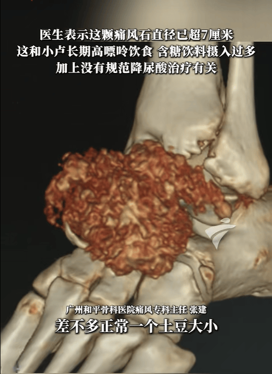 广东24岁男子脚上长出“土豆”，直径超过7厘米，走路都困难，以为是扭伤骨质增生，一查发现是痛风石，曾在14岁查出痛风